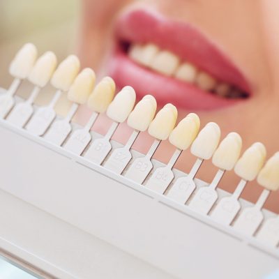 Beautiful european woman smile with healthy teeth whitening. Dental care concept. Set of implants with various shades of tone
