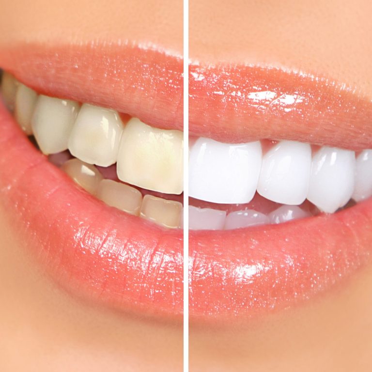 Mouth and teeth before and after whitening